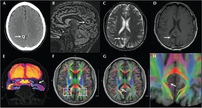 The Temporal Lobe as a Symptomatogenic Zone in Medial Parietal Lobe Epilepsy